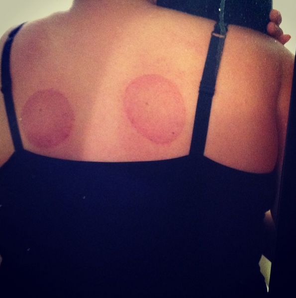 Lindsay's back after her first acupuncture and cupping therapy treatment.