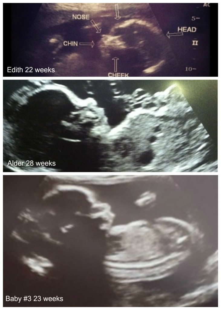 ultrasounds